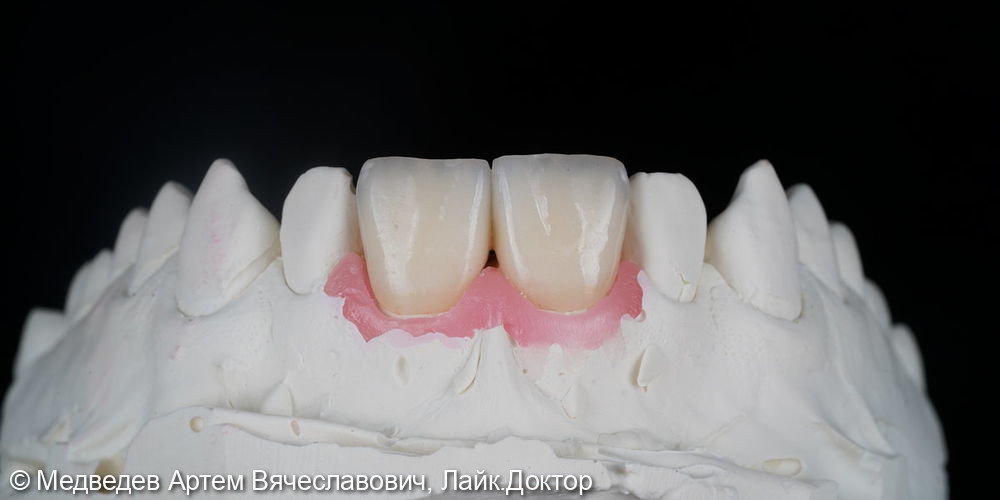 Виниры на фронтальные зубы - фото №2