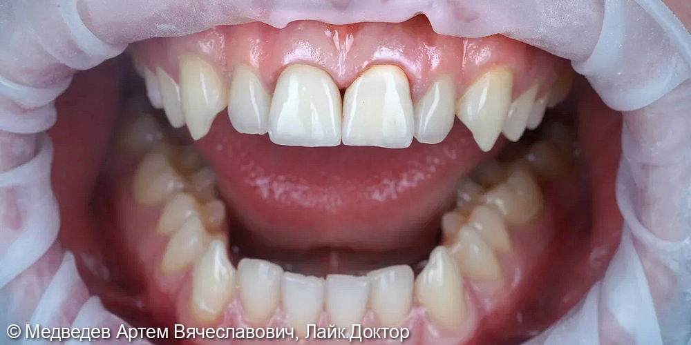 Виниры на фронтальные зубы - фото №3