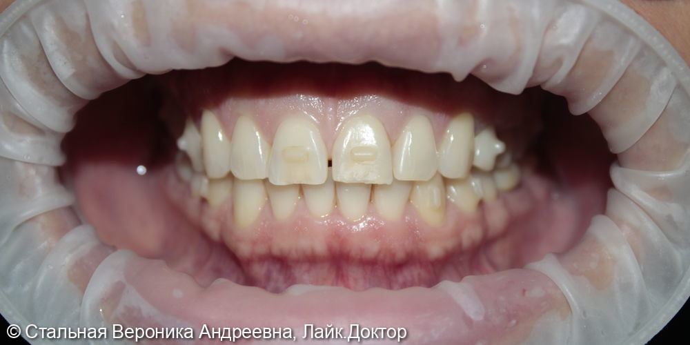 Виниры - фото №1