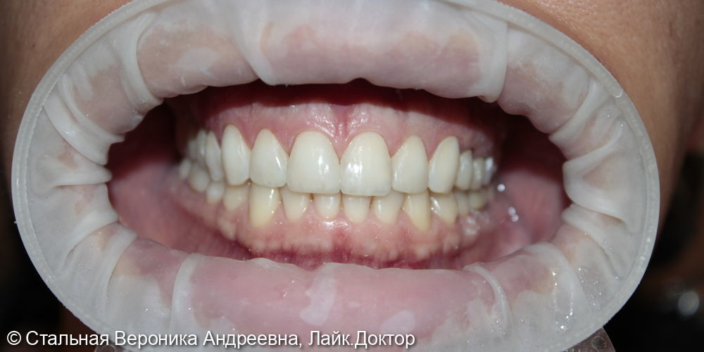 Виниры - фото №2