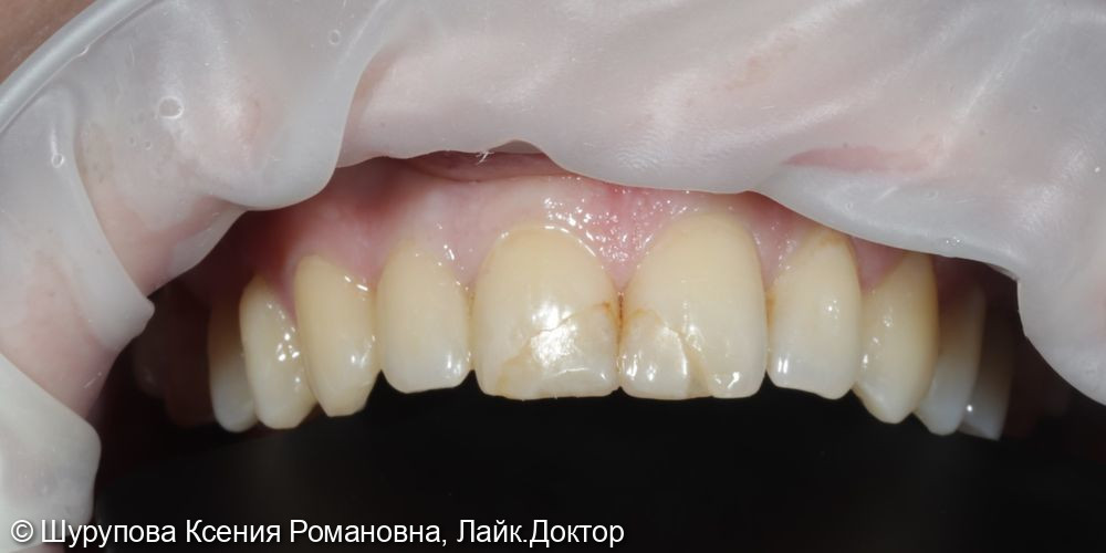Эстетическая реабилитация композитными реставрациями после травмы - фото №1