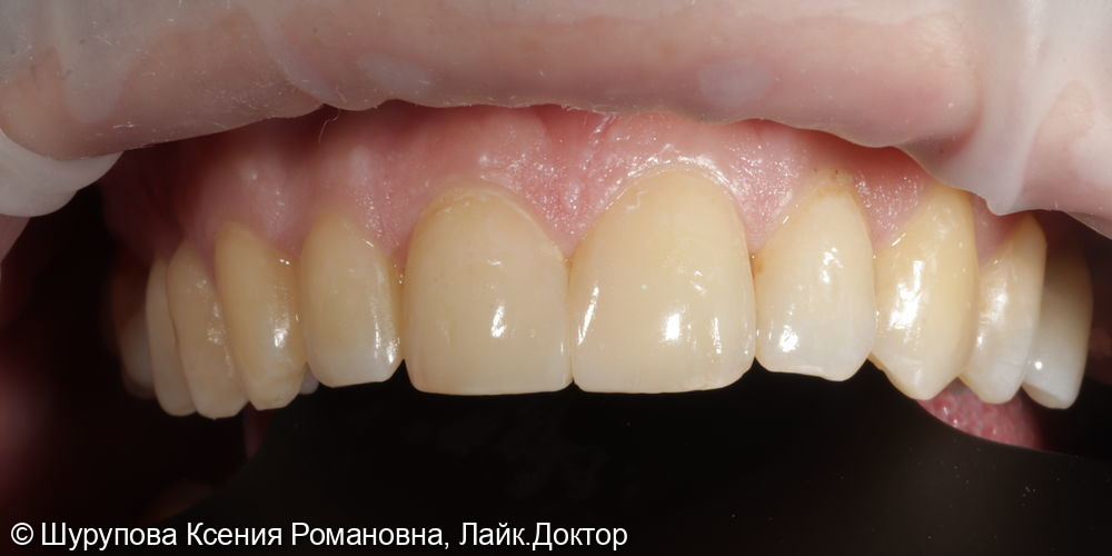 Эстетическая реабилитация композитными реставрациями после травмы - фото №2