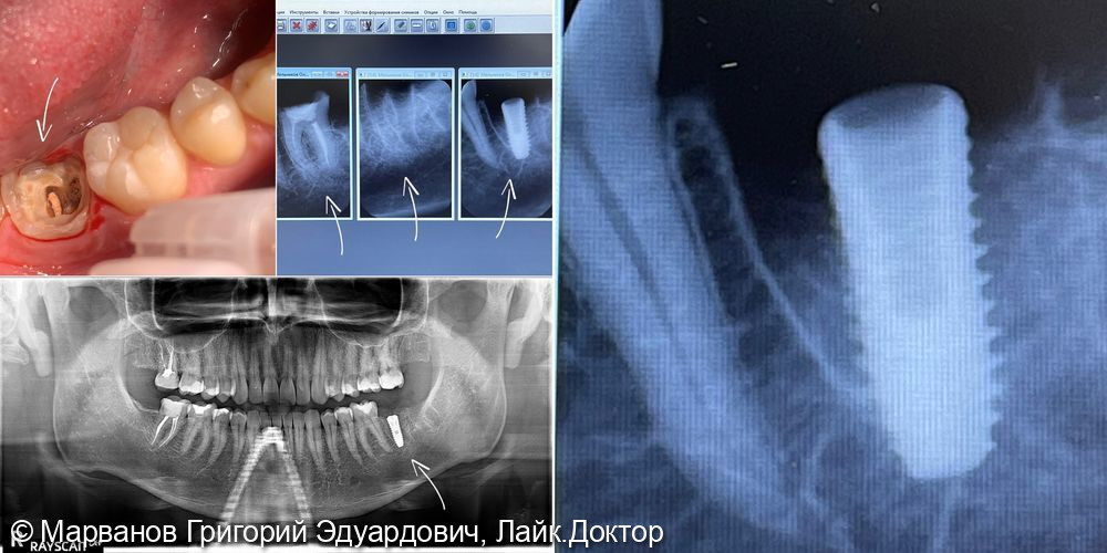Одномоментная имплантация зуба 3.7 (семерка слева на нижней челюсти) - фото №1