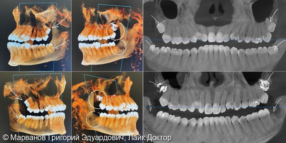 Удаление всех 4-х зубов мудрости вследствие скученного расположения зубов на верхней и нижней челюсти - фото №1