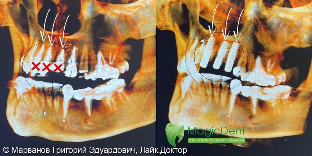 Одномоментная имплантация NobelActiv с костной пластикой фронтальной группы зубов - фото №1