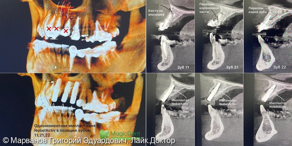 Одномоментная имплантация NobelActiv с костной пластикой фронтальной группы зубов - фото №2