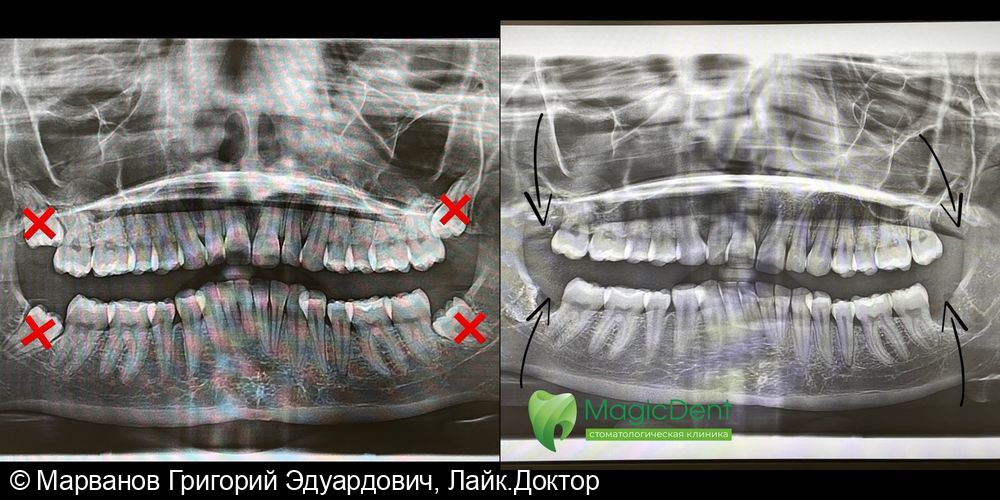 Удаление зубов мудрости у пациента перед ортодонтическим лечением - фото №1