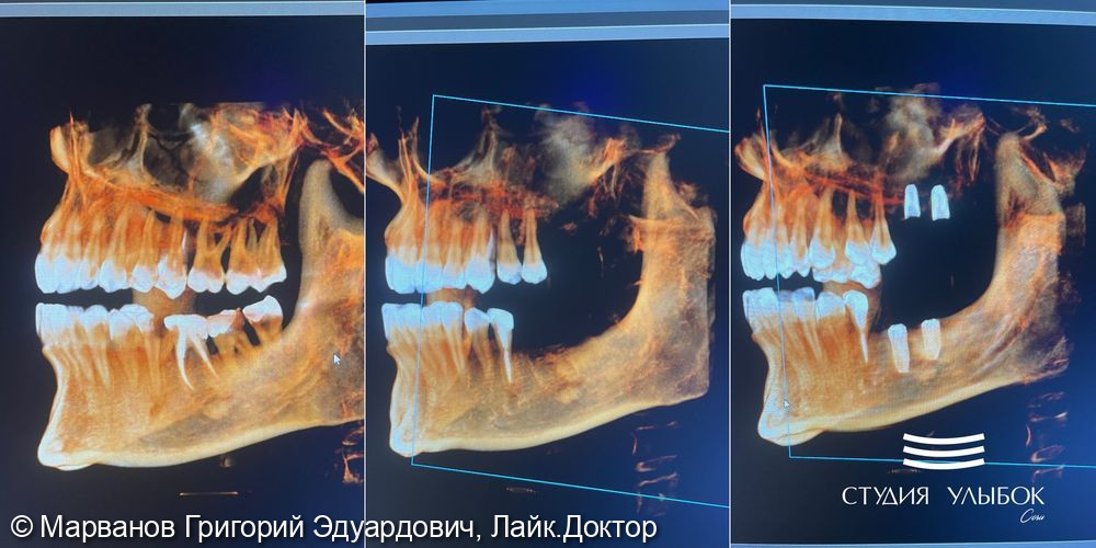 Имплантация зубов фото 3 · Сочи