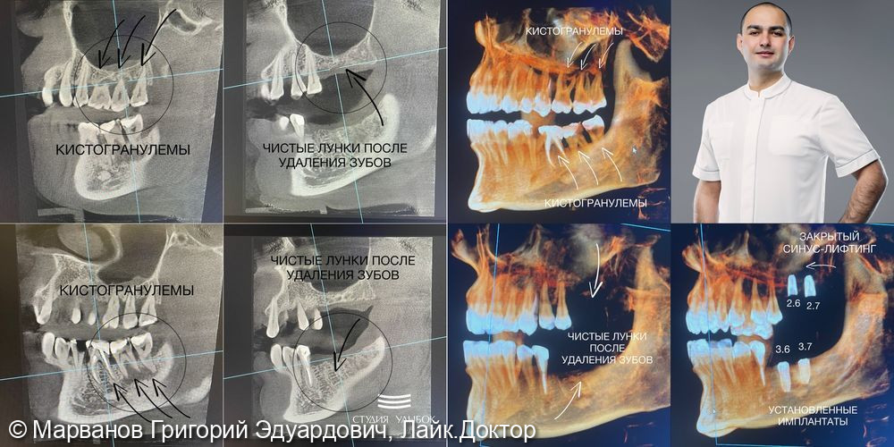 Имплантация зубов фото 2 · Сочи