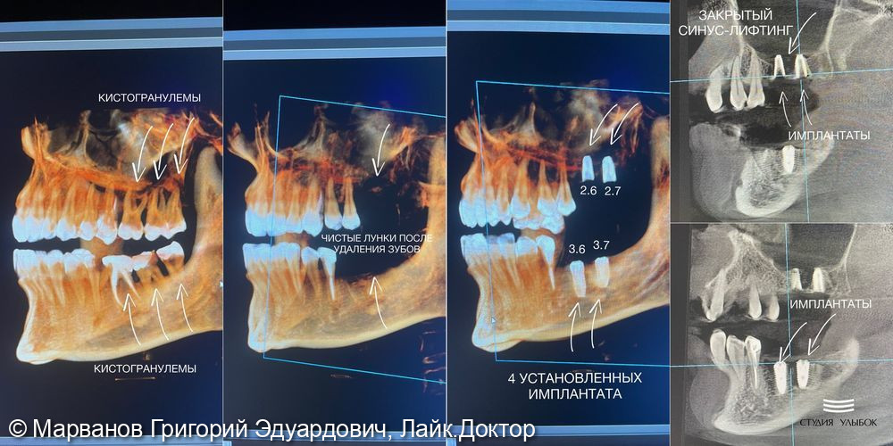 Имплантация зубов - фото №1