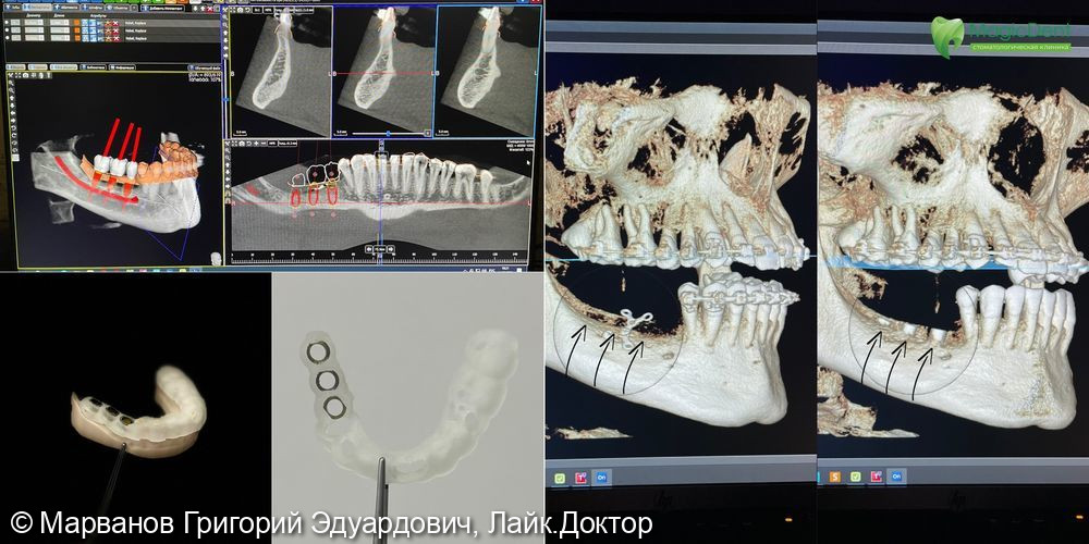 Кейс по имплантации зубов по цифровому навигационному хирургическому шаблону - фото №3
