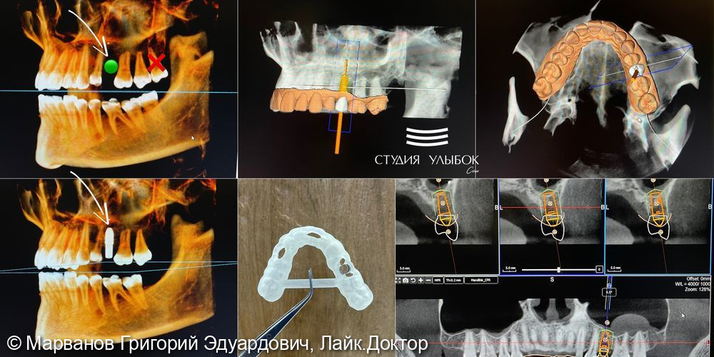 Кейс единичной детальной имплантации по навигационному хирургическому шаблону - фото №1