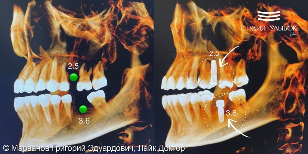 Дентальная имплантация Nobel одиночных зубов по навигационному хирургическому шаблону - фото №1