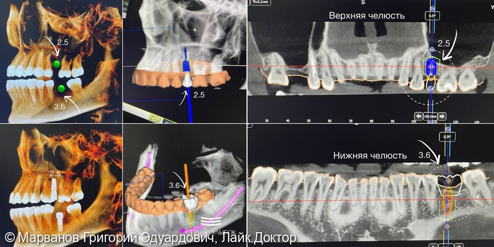 Дентальная имплантация Nobel одиночных зубов по навигационному хирургическому шаблону - фото №2