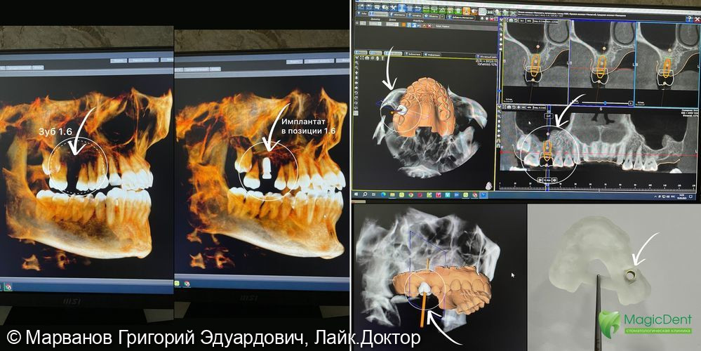 Клинический случай одиночной дентальной имплантации Nobel (Швейцария) - фото №1