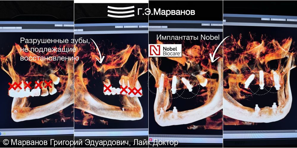 Клинический случай восстановления зубных рядов верхней челюсти «все на 4-х имплантатах NOBEL (Швеция)» и нижней челюсти условно-съемным протезом на балке - фото №2