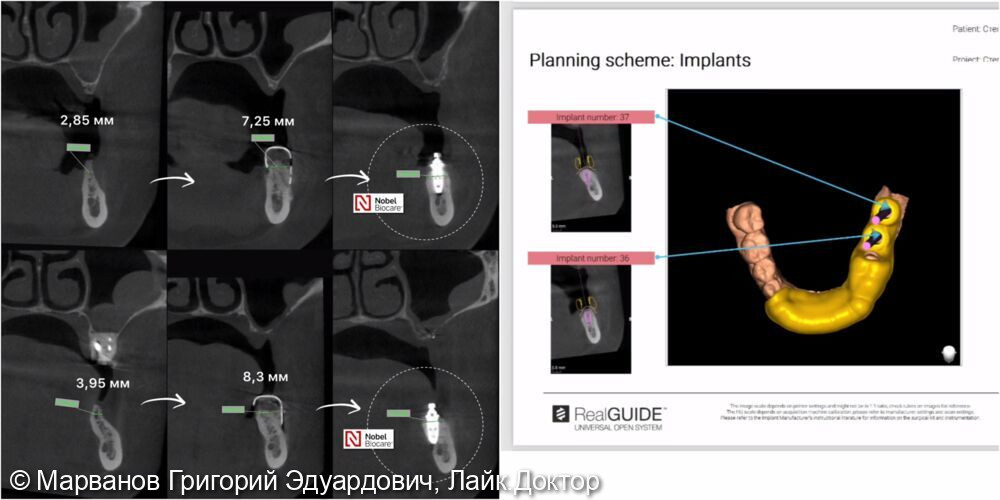 Кейс по наращиванию кости челюсти при дефиците костной ткани у пациентки с целью подготовки к дальнейшей дентальной имплантации - фото №1