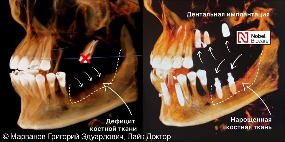 Кейс по наращиванию кости челюсти при дефиците костной ткани у пациентки с целью подготовки к дальнейшей дентальной имплантации - фото №5