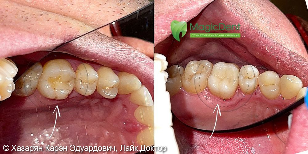 Лечение кариеса 26 (шестого зуба) в Сочи. Стоматология Magic Dent - фото №1
