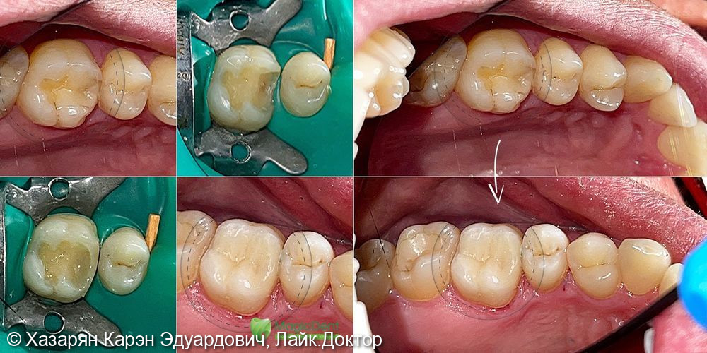 Лечение кариеса 26 (шестого зуба) в Сочи. Стоматология Magic Dent - фото №2