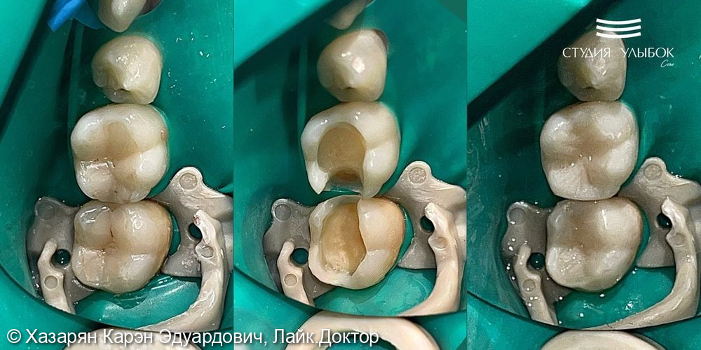 Лечение среднего кариеса 46 и 47 зубов у пациентки 28-ми лет - фото №1