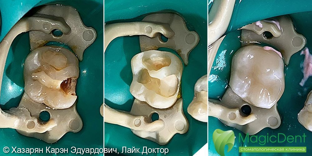 Лечение рецидива глубокого кариеса 16-го зуба с сохранением нерва (витальности зуба) - фото №1