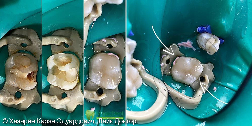 Лечение рецидива глубокого кариеса 16-го зуба с сохранением нерва (витальности зуба) - фото №2