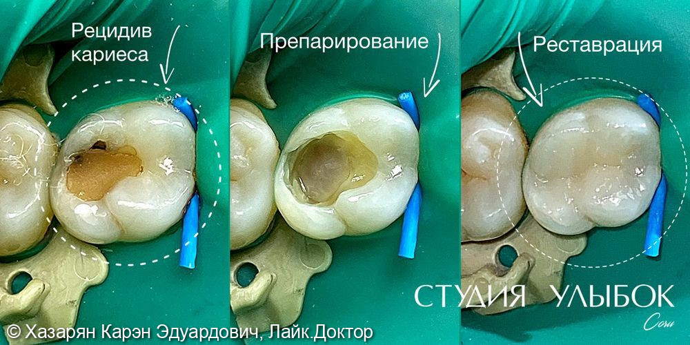 Рецидив кариеса. Лечение - фото №1