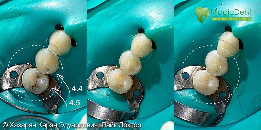 Лечения кариеса 44,45 зубов - фото №1