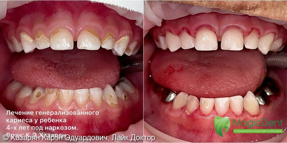 Лечение генереализованного кариеса у ребенка 4-х лет в условиях общей анестезии (наркоза) - фото №1