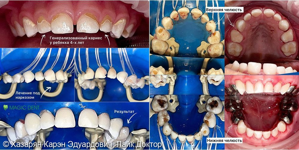 Лечение генереализованного кариеса у ребенка 4-х лет в условиях общей анестезии (наркоза) - фото №4