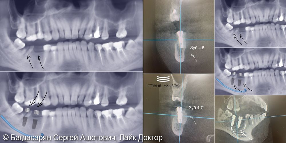 Имплантации зубов Dentium (46 и 47 зубов) по хирургическим шаблонам - фото №1