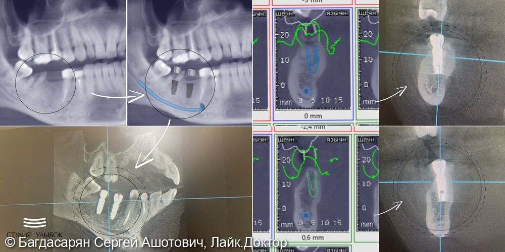 Имплантации зубов Dentium (46 и 47 зубов) по хирургическим шаблонам - фото №2