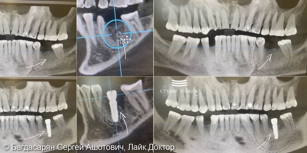 Операция по имплантации зуба, установлен имплантат Dentium (Ю. Корея) в области 3.6 - фото №1