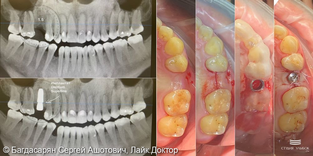 Одномоментная имплантация Dentium Suprline зуба 1.5 по цифровому хирургическому шаблону - фото №1
