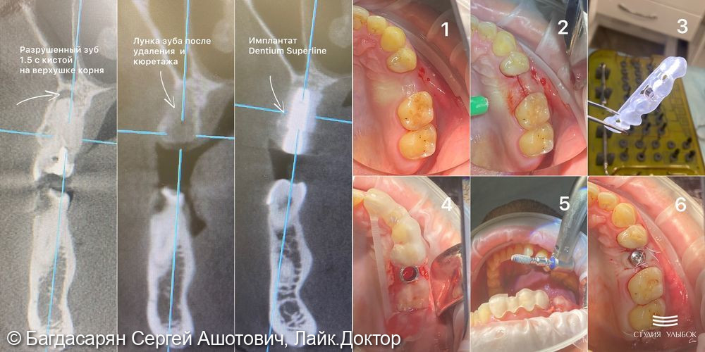 Одномоментная имплантация Dentium Suprline зуба 1.5 по цифровому хирургическому шаблону - фото №4