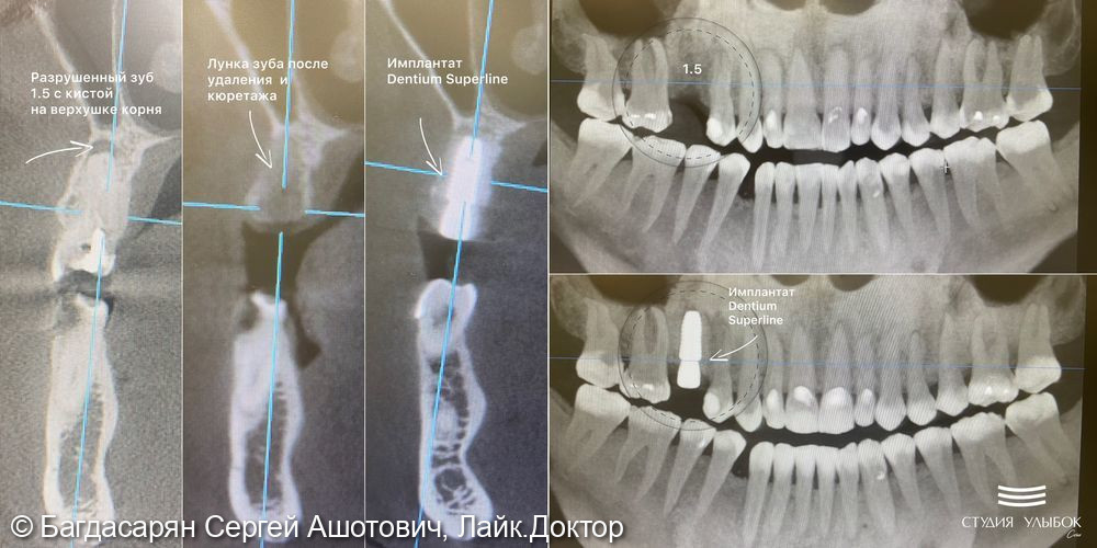 Одномоментная имплантация Dentium Suprline зуба 1.5 по цифровому хирургическому шаблону - фото №2