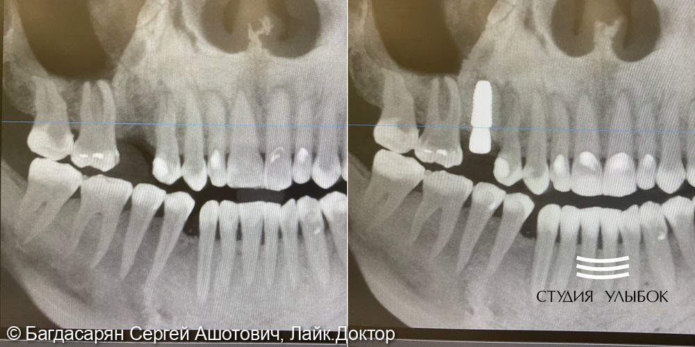 Одномоментная имплантация Dentium Suprline зуба 1.5 по цифровому хирургическому шаблону - фото №3