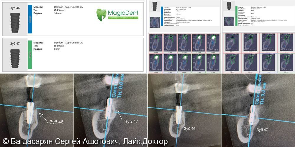 Установка имплантатов по навигационному протоколу с использованием хирургического шаблона - фото №4