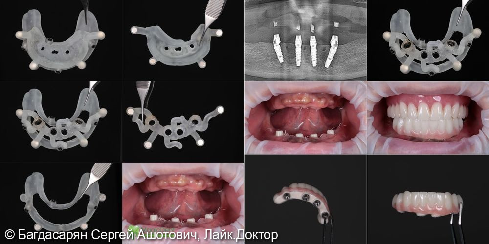 Клинический случай тотального протезирования на имплантатах нижней челюсти по системе all-on-4 - фото №2