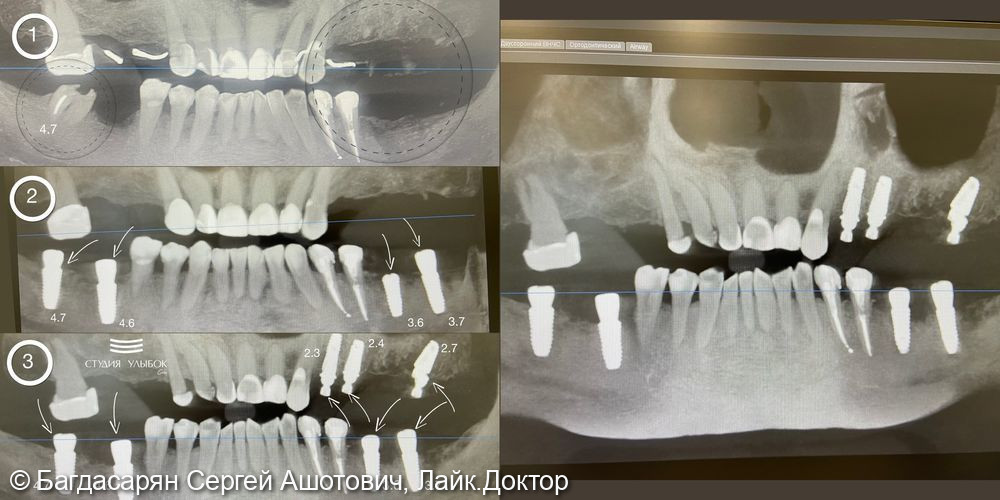Установка имплантатов на верхней и нижней челюсти у пациента 57-ми лет - фото №1