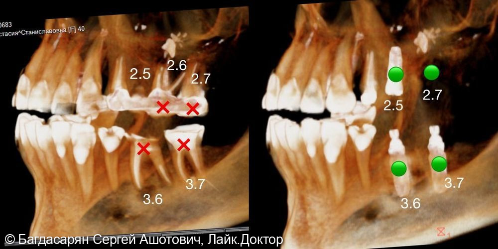 Клинический случай одномоментной и отсроченной имплантации зубов с добавление костного материала и проведением процедуры по хирургическому навигационному шаблону - фото №1