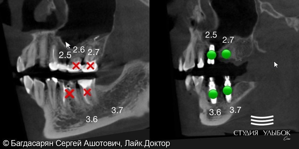 Клинический случай одномоментной и отсроченной имплантации зубов с добавление костного материала и проведением процедуры по хирургическому навигационному шаблону - фото №2