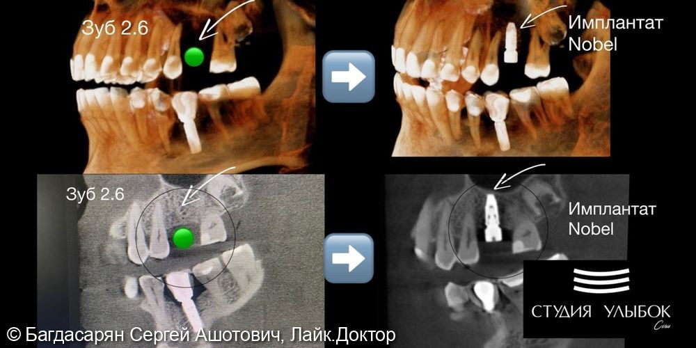 Имплантация Nobel Beocare (Швейцария) в позиции зуба 2.6 - фото №1