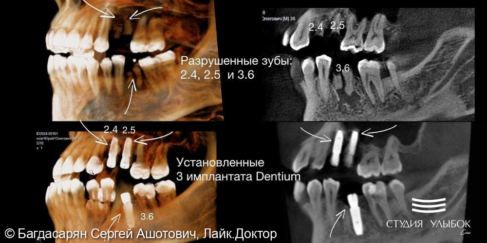 Одномоментная имплантация Dentium (Южная Корея) в позиции зубов 24,25 и 36 с использованием навигационного хирургического шаблона - фото №1