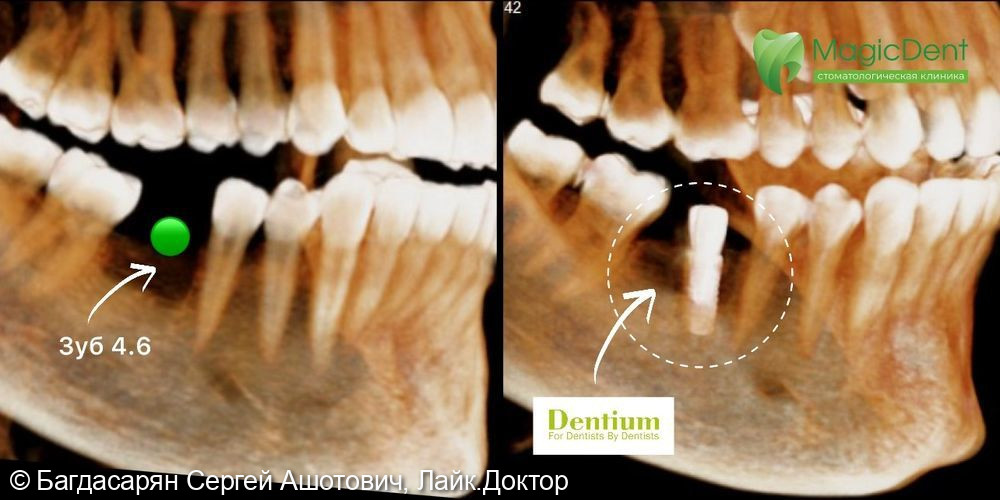 От смоченная детальная имплантация DENTIUM зуба 4.6 - фото №1