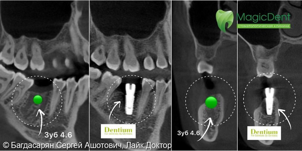 От смоченная детальная имплантация DENTIUM зуба 4.6 - фото №2