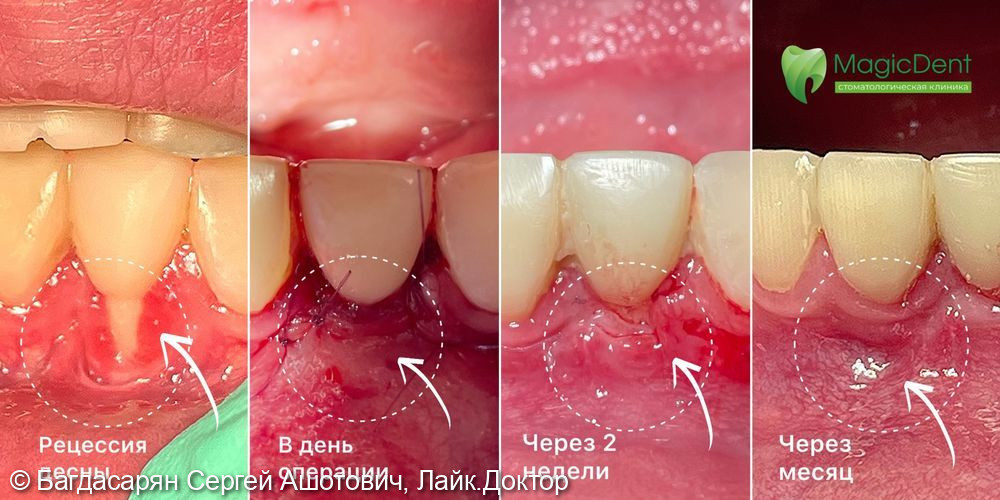 Лечение рецессии десны. Зуб 3.1 - фото №1