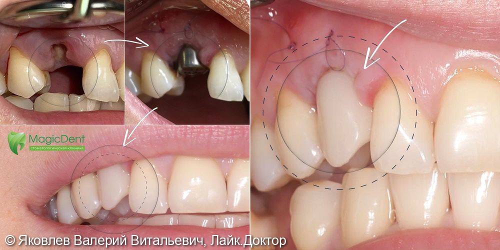 Одномоментная имплантация зуба с установкой временной коронки вследствие травмы (перелома) зуба - фото №1