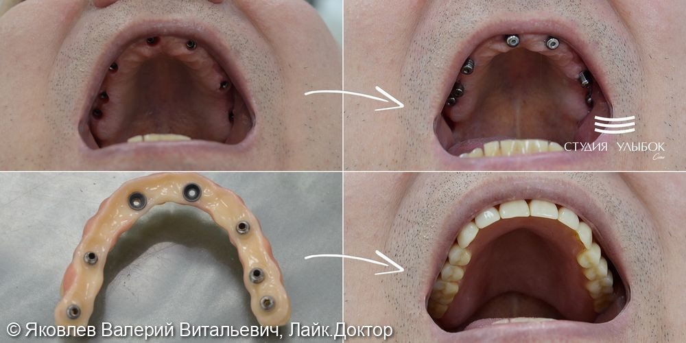 Результат тотального протезирования у пациента с полным отсутствием зубов на верхней челюсти - фото №1